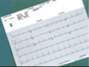 Burdick ECG/EKG Paper New 10/Bx
